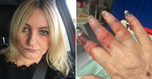 Ledvinový kamínek způsobil fatální škody, ženu čekala amputace